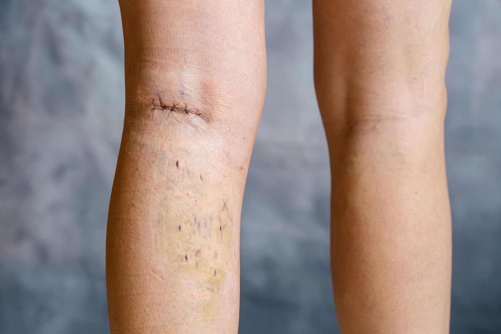 phlebecotomy for varicose veins