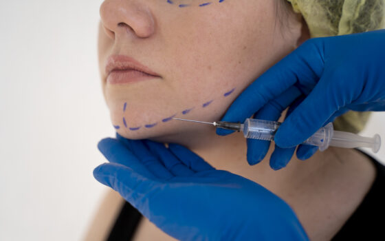 Dermal Fillers vs PDO Threads